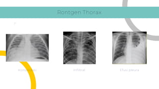 Hasil Rontgen Thorax DIAGNOSIS TUBERKULOSIS ANAK DAN REMAJA-3.pdf
