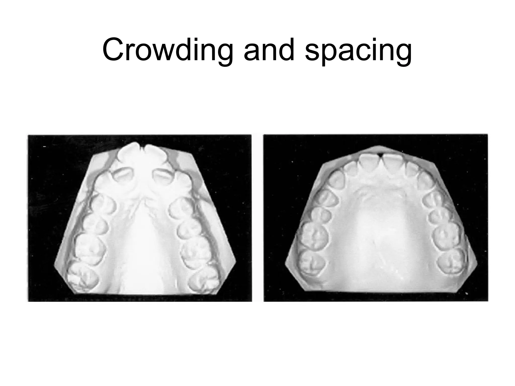 Crowding and spacing
