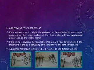  ADJUSTMENT FOR TILTED MOLAR:
 If the encroachment is slight, the problem can be remedied by restoring or
recontouring t...
