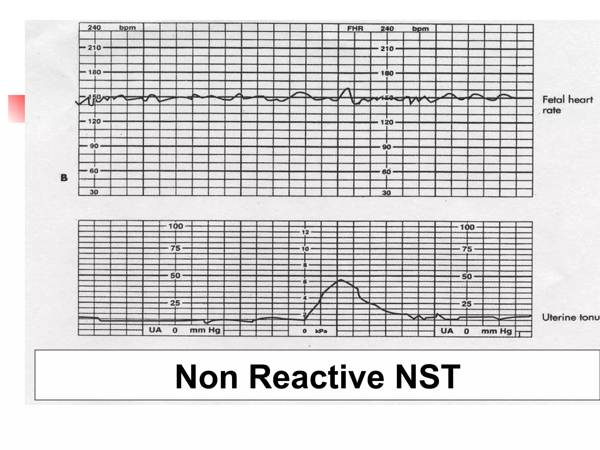 Non Reactive NST  Non Reactive NST 