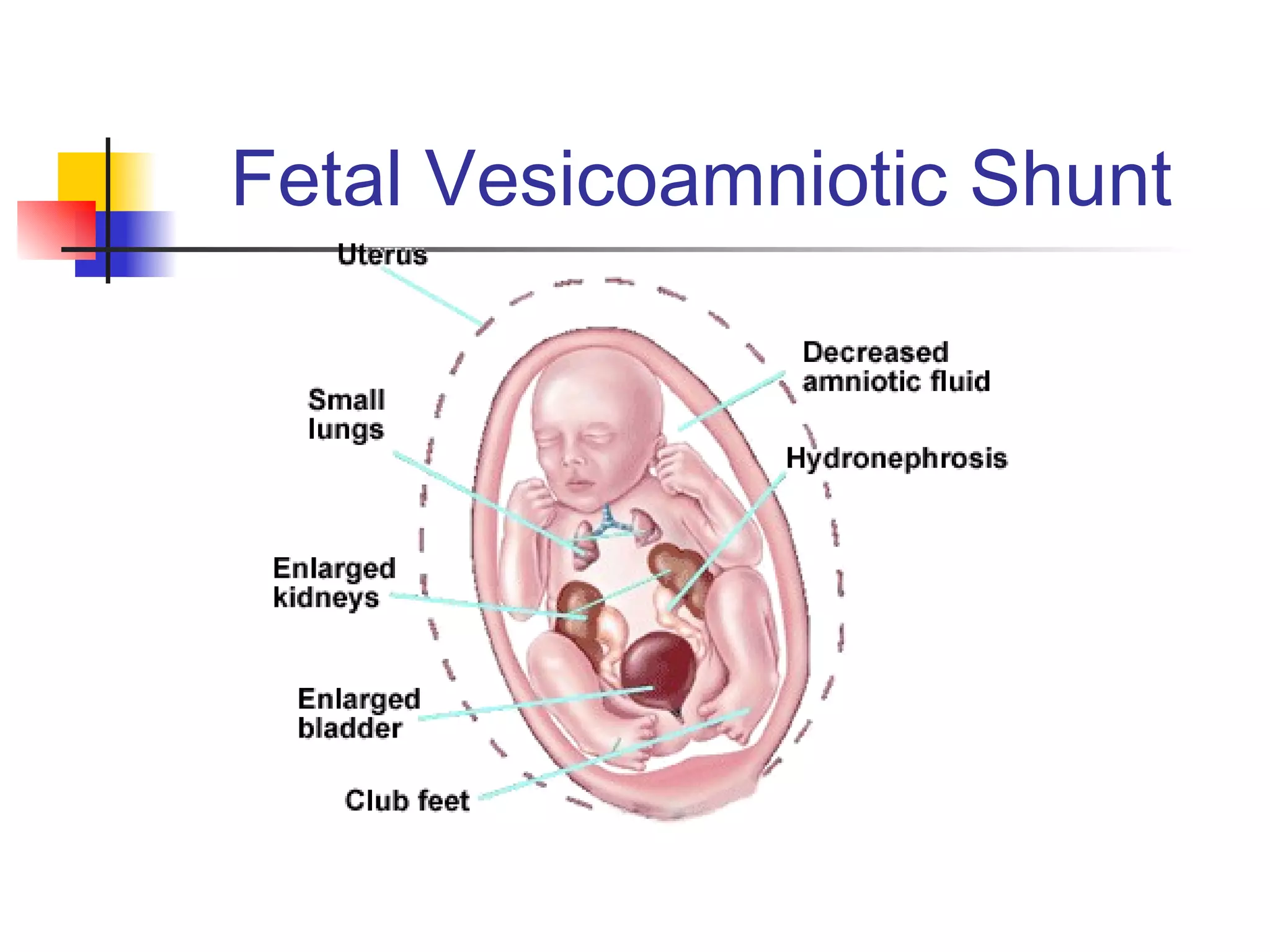 Fetal Vesicoamniotic Shunt 