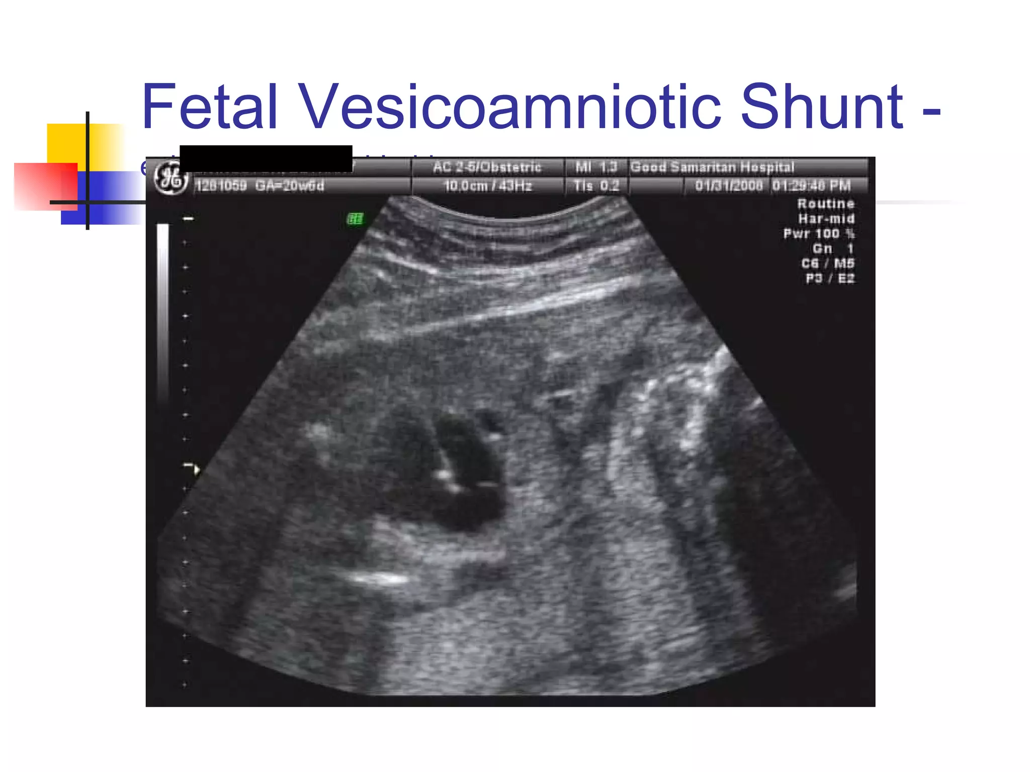 Fetal Vesicoamniotic Shunt -  echotip needle in bladder 