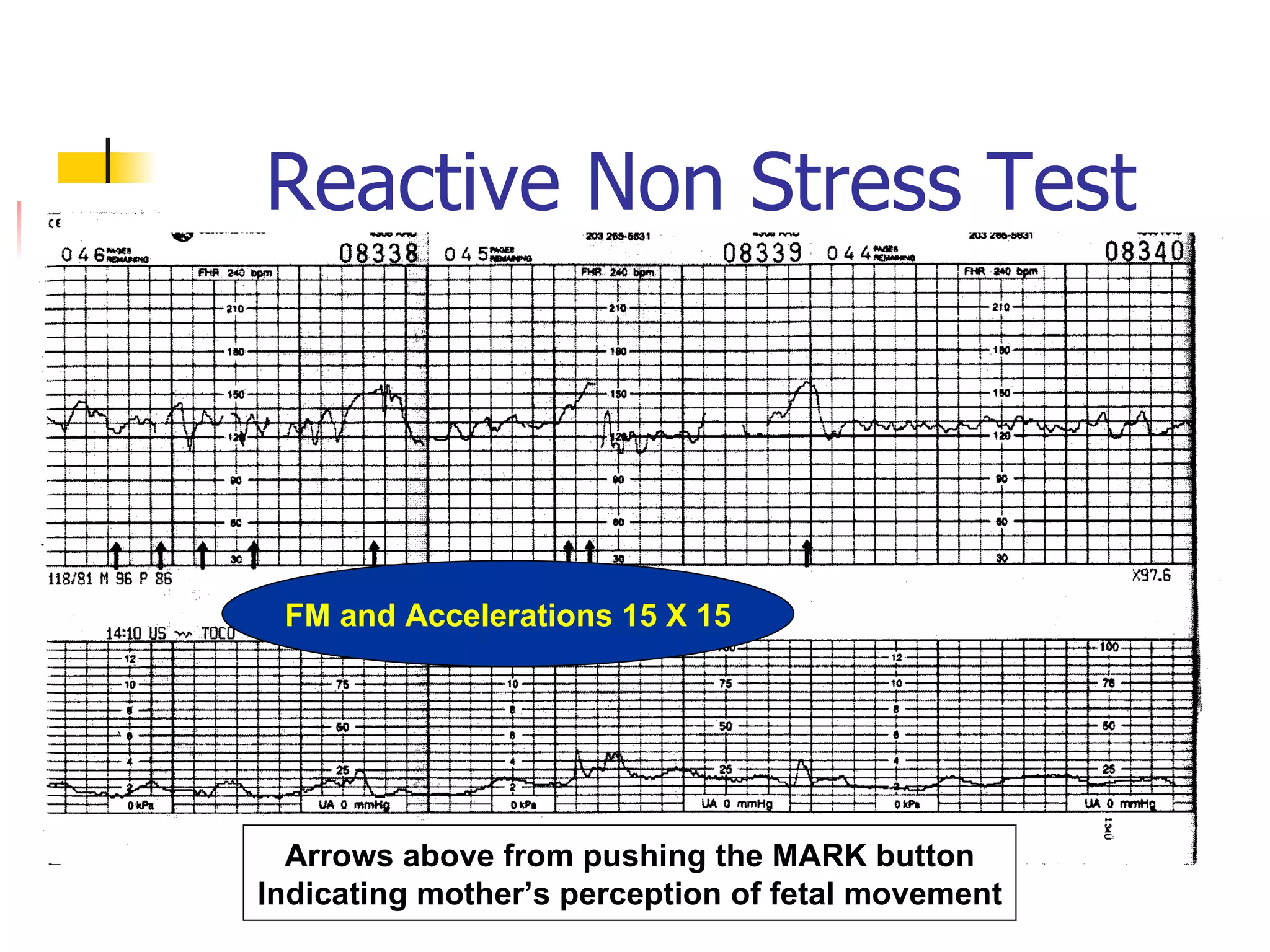 Reactive Non Stress Test Arrows above from pushing the MARK button Indicating mother’s perception of fetal movement FM and Accelerations 15 X 15 