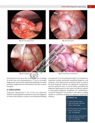 333
CHAPTER 24: Diagnostic Laparoscopy
Fig. 14: Acute appendicitis. Fig. 15: Diverticulum.
Fig. 16: Impalpable testes. Fig. 17: Perforation of small bowel.
are equivocal. It can be performed safely in an inpatient or
outpatient setting, potentially expediting diagnosis, and
treatment. This laparoscopic procedure helps to achieve
the final diagnosis without any significant complication
and less operative time, it can be safely concluded that
diagnostic laparoscopy is a safe, quick, and effective adjunct
to nonsurgical diagnostic modalities, for establishing a
conclusive diagnosis, but whether it will replace imaging
studies as a primary modality for diagnosis needs more
evidence.
of instrument is not done then wound infection or leakage
of ascites may occur postoperatively. Failure to accurately
diagnose the extent of intra-abdominal pathology is another
potential complication for which patient may have to go for
resurgery.
CONCLUSION
Diagnostic laparoscopy is one of the very important
methods of investigation for patients in whom the diagnosis
or extent of the disease is unclear or the abdominal findings
 