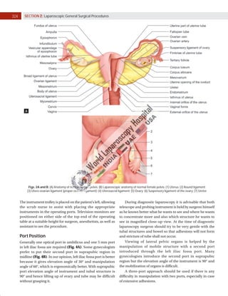 324 SECTION 2: Laparoscopic General Surgical Procedures
Figs. 2A and B: (A) Anatomy of normal female pelvis; (B) Laparoscopic anatomy of normal female pelvis: (1) Uterus; (2) Round ligament;
(3) Utero-ovarian ligament (proper ovarian ligament); (4) Uterosacral ligament; (5) Ovary; (6) Suspensory ligament of the ovary; (7) Ureter.
A
B
The instrument trolley is placed on the patient’s left, allowing
the scrub nurse to assist with placing the appropriate
instruments in the operating ports. Television monitors are
positioned on either side of the top end of the operating
table at a suitable height for surgeon, anesthetists, as well as
assistant to see the procedure.
Port Position
Generally one optical port in umbilicus and one 5 mm port
in left iliac fossa are required (Fig. 4A). Some gynecologists
prefer to put their second port in suprapubic region in
midline (Fig. 4B). In our opinion, left iliac fossa port is better
because it gives elevation angle of 30° and manipulation
angle of 60°, which is ergonomically better. With suprapubic
port elevation angle of instrument and tubal structure is
90° and hence lifting up of ovary and tube may be difficult
without grasping it.
During diagnostic laparoscopy it is advisable that both
telescope and probing instrument is held by surgeon himself
as he knows better what he wants to see and where he wants
to concentrate more and also which structure he wants to
see in magnified close-up view. At the time of diagnostic
laparoscopy surgeon should try to be very gentle with the
tubal structures and bowel so that adhesions will not form
and stricture of tube shall not occur.
Viewing of lateral pelvic organs is helped by the
manipulation of mobile structure with a second port
introduced through the left iliac fossa port. Many
gynecologists introduce the second port in suprapubic
region but the elevation angle of the instrument is 90° and
the mobilization of organs is difficult.
A three-port approach should be used if there is any
difficulty in manipulation with two ports, especially in case
of extensive adhesions.
 