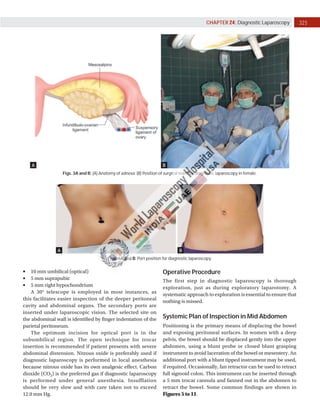 325
CHAPTER 24: Diagnostic Laparoscopy
Figs. 3A and B: (A) Anatomy of adnexa; (B) Position of surgical team for diagnostic laparoscopy in female.
A B
Figs. 4A and B: Port position for diagnostic laparoscopy.
A B
	
■ 10 mm umbilical (optical)
	
■ 5 mm suprapubic
	
■ 5 mm right hypochondrium
A 30° telescope is employed in most instances, as
this facilitates easier inspection of the deeper peritoneal
cavity and abdominal organs. The secondary ports are
inserted under laparoscopic vision. The selected site on
the abdominal wall is identified by finger indentation of the
parietal peritoneum.
The optimum incision for optical port is in the
subumbilical region. The open technique for trocar
insertion is recommended if patient presents with severe
abdominal distension. Nitrous oxide is preferably used if
diagnostic laparoscopy is performed in local anesthesia
because nitrous oxide has its own analgesic effect. Carbon
dioxide (CO2) is the preferred gas if diagnostic laparoscopy
is performed under general anesthesia. Insufflation
should be very slow and with care taken not to exceed
12.0 mm Hg.
Operative Procedure
The first step in diagnostic laparoscopy is thorough
exploration, just as during exploratory laparotomy. A
systematic approach to exploration is essential to ensure that
nothing is missed.
Systemic Plan of Inspection in Mid Abdomen
Positioning is the primary means of displacing the bowel
and exposing peritoneal surfaces. In women with a deep
pelvis, the bowel should be displaced gently into the upper
abdomen, using a blunt probe or closed blunt grasping
instrument to avoid laceration of the bowel or mesentery. An
additional port with a blunt tipped instrument may be used,
if required. Occasionally, fan retractor can be used to retract
full sigmoid colon. This instrument can be inserted through
a 5 mm trocar cannula and fanned out in the abdomen to
retract the bowel. Some common findings are shown in
Figures 5 to 11.
 