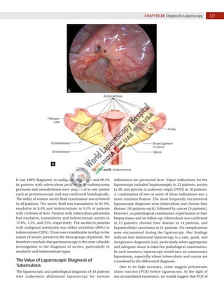 327
CHAPTER 24: Diagnostic Laparoscopy
Figs. 7A and B: Endometriosis.
A
B
It was 100% diagnostic in malignant peritonitis and 89.5%
in patients with tuberculous peritonitis. Pseudomyxoma
peritonei and mesothelioma were suspected in one patient
each at peritoneoscopy and was confirmed histologically.
The utility of routine ascitic fluid examination was reviewed
in all patients. The ascitic fluid was transudative in 81.9%,
exudative in 8.6% and indeterminate in 9.5% of patients
with cirrhosis of liver. Patients with tuberculous peritonitis
had exudative, transudative and indeterminate ascites in
71.8%, 3.2%, and 25%, respectively. The ascites in patients
with malignant peritonitis was either exudative (80%) or
indeterminate (20%). There was considerable overlap in the
nature of ascites present in the three groups of patients. We
therefore conclude that peritoneoscopy is the most valuable
investigation in the diagnosis of ascites, particularly in
exudative and indeterminate types.
The Value of Laparoscopic Diagnosis of
Tuberculosis
The laparoscopic and pathological diagnosis of 43 patients
who underwent abdominal laparoscopy for various
indications are presented here. Major indications for the
laparoscopy included hepatomegaly in 32 patients, ascites
in 28, and pyrexia of unknown origin (PUO) in 18 patients.
A combination of two or more of these indications was a
more common feature. The most frequently encountered
laparoscopic diagnoses were tuberculosis and chronic liver
disease (16 patients each), followed by cancer (9 patients).
However, on pathological examination of peritoneal or liver
biopsy tissue and on follow-up, tuberculosis was confirmed
in 12 patients, chronic liver disease in 14 patients, and
hepatocellular carcinoma in 11 patients. No complications
were encountered during the laparoscopy. Our findings
indicate that abdominal laparoscopy is a safe, quick, and
inexpensive diagnostic tool, particularly when appropriate
and adequate tissue is taken for pathological examination.
In such instances, laparoscopy would save an unnecessary
laparotomy, especially where tuberculosis and cancer are
considered in the differential diagnosis.
Due to its high accuracy, some suggest polymerase
chain reaction (PCR) before laparoscopy. In the light of
our accumulated experience, we would suggest that PCR of
 