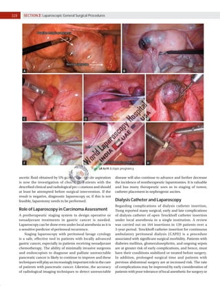 328 SECTION 2: Laparoscopic General Surgical Procedures
Figs. 8A to H: Ectopic pregnancy.
A B
C
F
D
G
E
H
ascetic fluid obtained by US-guided fine-needle aspiration
is now the investigation of choice for patients with the
described clinical and radiological presentations and should
at least be attempted before surgical intervention. If the
result is negative, diagnostic laparoscopy or, if this is not
feasible, laparotomy needs to be performed.
Role of Laparoscopy in Carcinoma Assessment
A pretherapeutic staging system to design operative or
neoadjuvant treatments in gastric cancer is needed.
Laparoscopy can be done even under local anesthesia as it is
a sensitive predictor of peritoneal recurrence.
Staging laparoscopy with peritoneal lavage cytology
is a safe, effective tool in patients with locally advanced
gastric cancer, especially in patients receiving neoadjuvant
chemotherapy. The ability of minimally invasive surgeons
and endoscopists to diagnose and palliate unresectable
pancreatic cancer is likely to continue to improve and these
techniqueswillplayanincreasinglyimportantroleinthecare
of patients with pancreatic cancer. Likewise, the accuracy
of radiological imaging techniques to detect unresectable
disease will also continue to advance and further decrease
the incidence of nontherapeutic laparotomies. It is valuable
and has many therapeutic uses as in staging of tumor,
catheter placement in nephrogenic ascites.
Dialysis Catheter and Laparoscopy
Regarding complications of dialysis catheter insertion,
Tiong reported many surgical, early and late complications
of dialysis catheter of open Tenckhoff catheter insertion
under local anesthesia in a single institution. A review
was carried out on 164 insertions in 139 patients over a
3-year period. Tenckhoff catheter insertion for continuous
ambulatory peritoneal dialysis (CAPD) is a procedure
associated with significant surgical morbidity. Patients with
diabetes mellitus, glomerulonephritis, and ongoing sepsis
are at greater risk of early complications, and hence, must
have their conditions stabilized or treated before surgery.
In addition, prolonged surgical time and patients with
previous abdominal surgery are at increased risk. The rate
of complications may be improved by early consideration of
patients with poor tolerance of local anesthetic for surgery or
 