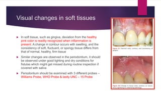 Visual changes in soft tissues
 In soft tissue, such as gingiva, deviation from the healthy
pink color is readily recognized when inflammation is
present. A change in contour occurs with swelling, and the
consistency of soft, fluctuant, or spongy tissue differs from
that of normal, healthy, firm tissue
 Similar changes are observed in the periodontium, it should
be observed under good lighting and dry conditions for
fistulas which might get missed during routine inspection if
covered with saliva
 Periodontium should be examined with 3 different probes –
Williams Probe, WHO Probe & lastly UNC – 15 Probe
 