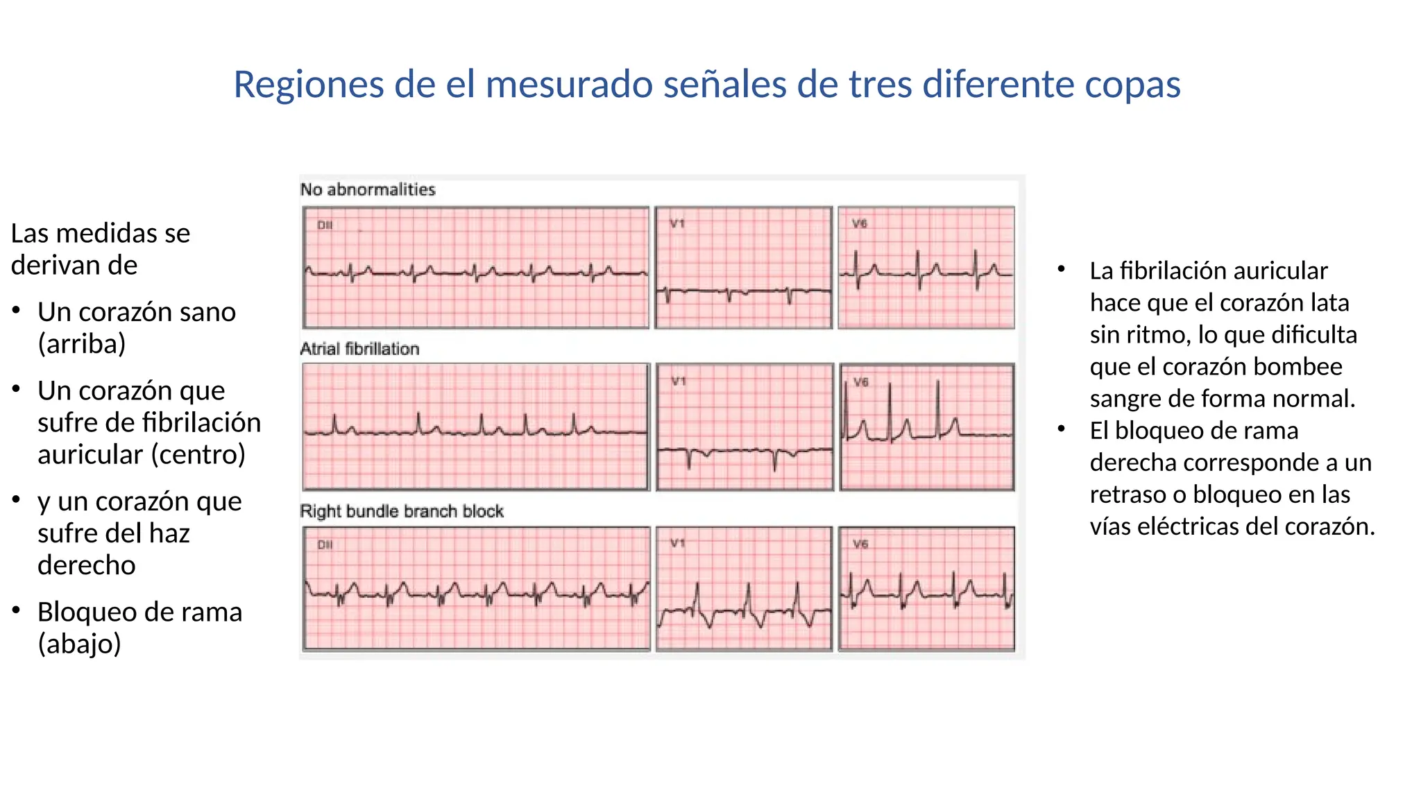 Las medidas se
derivan de
• Un corazón sano
(arriba)
• Un corazón que
sufre de fibrilación
auricular (centro)
• y un corazón que
sufre del haz
derecho
• Bloqueo de rama
(abajo)
• La fibrilación auricular
hace que el corazón lata
sin ritmo, lo que dificulta
que el corazón bombee
sangre de forma normal.
• El bloqueo de rama
derecha corresponde a un
retraso o bloqueo en las
vías eléctricas del corazón.
Regiones de el mesurado señales de tres diferente copas
 