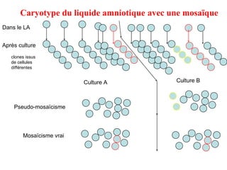 Dans le LA Après culture  clones issus de cellules différentes Culture A Culture B Pseudo-mosaïcisme Mosaïcisme vrai Caryotype du liquide amniotique   avec une mosaïque 