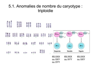 5.1. Anomalies de nombre du caryotype : triploidie 69,XXXou XXY ou XYY 69,XXX ou XYY 69,XXX ou XXY 