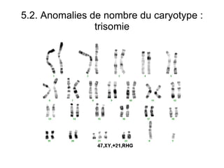 5.2. Anomalies de nombre du caryotype : trisomie 