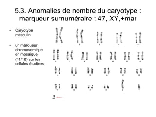 5.3. Anomalies de nombre du caryotype : marqueur surnuméraire : 47, XY,+mar Caryotype masculin un marqueur chromosomique en mosaique  (11/16) sur les cellules étudiées 