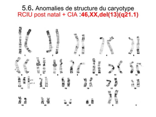5.6 .  Anomalies de structure du caryotype RCIU post natal + CIA  : 46,XX,del(13)(q21.1) 
