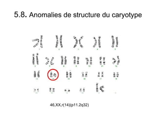 5.8 .  Anomalies de structure du caryotype 46,XX,r(14)(p11.2q32) 