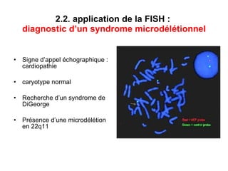 2.2. application de la FISH :  diagnostic   d’un syndrome microdélétionnel Signe d’appel échographique : cardiopathie caryotype normal Recherche d’un syndrome de DiGeorge Présence d’une microdélétion en 22q11 