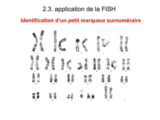 2.3. application de la FISH     Identification d’un petit marqueur surnuméraire 