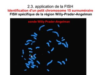 2.3. application de la FISH  Identification d’un petit chromosome 15 surnuméraire   FISH spécifique de la région Willy-Prader-Angelman 
