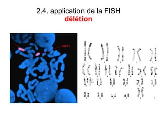 2.4. application de la FISH  délétion  