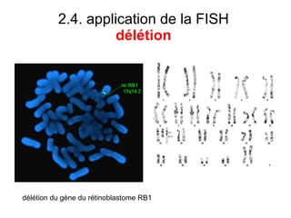 2.4. application de la FISH  délétion  délétion du gène du rétinoblastome RB1 