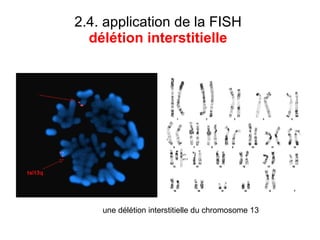 2.4. application de la FISH  délétion interstitielle  une délétion interstitielle du chromosome 13 