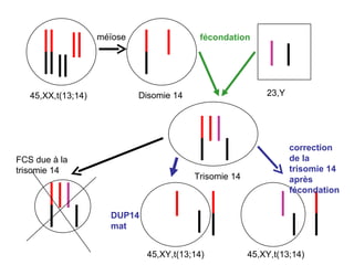 FCS due à la trisomie 14 correction de la trisomie 14 après fécondation DUP14 mat 45,XX,t(13;14) 23,Y méïose fécondation Disomie 14 45,XY,t(13;14) 45,XY,t(13;14) Trisomie 14 