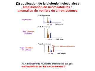 (2) application de la biologie moléculaire :   amplification de microsatellites :  anomalies du nombre de chromosomes PCR fluorescente multiplexe quantitative sur   des  microsatellites sur les chromosomes 21 