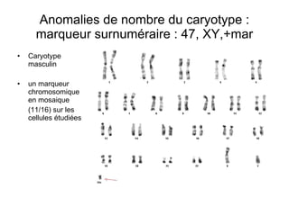 Anomalies de nombre du caryotype : marqueur surnuméraire : 47, XY,+mar Caryotype masculin un marqueur chromosomique en mosaique  (11/16) sur les cellules étudiées 