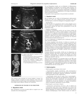 Radiodiagnostic Diagnostic anténatal des uropathies malformatives 34-550-A-20 
*A 
*B 
l’aire rénale la plus profonde est souvent difficile à imager. Les 
images coliques occupent la fosse lombaire vide et le rein 
controlatéral est souvent le siège d’une hypertrophie compensatrice. 
Une ectopie rénale, difficile à déceler, est à rechercher. 
ANOMALIES DE VOLUME ET DE STRUCTURE 
¦ Hypoplasie rénale 
Elle correspond à un rein de petite taille en rapport avec une 
anomalie de son développement. 
En cas d’hypoplasie simple, uni- ou bilatérale, la différenciation 
corticomédullaire est respectée et la fonction rénale normale. Les 
formes unilatérales mineures ne sont en général pas dépistées en 
anténatal. En revanche, les hypoplasies importantes et bilatérales 
peuvent être associées à un oligoamnios et à un risque d’insuffisance 
rénale en période néonatale. 
L’hypoplasie rénale segmentaire n’est pas décrite en anténatal. 
¦ Dysplasie rénale 
Elle est définie par un arrêt du développement embryonnaire 
normal du rein avec différenciation anormale du tissu 
métanéphrogène, et doit être distinguée de l’hypoplasie simple [8]. 
– Hypodysplasie. 
Le rein est petit et le parenchyme rénal est plus échogène que le 
foie. Il existe une dédifférenciation corticomédullaire et des 
microkystes répartis de façon non systématisée au sein du 
parenchyme rénal. 
– Dysplasie multikystique. 
Il semblerait actuellement qu’elle soit une forme extrême de 
dysplasie obstructive [9]. Dans sa forme typique, le plus souvent 
unilatérale (75 %), dépistée au deuxième trimestre car volumineuse, 
cette masse est constituée de kystes transsonores de taille inégale, 
juxtaposés, séparés par des travées hyperéchogènes fibreuses. Le 
bassinet n’est pas repérable et il n’existe pas de structure 
parenchymateuse rénale normale (fig 3A). 
En cas de duplication, la dysplasie peut n’intéresser qu’un pôle 
rénal, souvent le supérieur. 
Des formes atypiques sont décrites : la forme en couronne ou 
pseudohydronéphrotique où les kystes semblent répartis de façon 
systématisée en zone sous-capsulaire ; les formes atrophiques ou 
hypoplasiques, où le rein se résume à quelques petites structures 
kystiques contiguës. La fonction rénale dépend du rein controlatéral 
qui présente souvent une hypertrophie compensatrice. L’évolution 
des reins dysplasiques est variable, souvent vers l’involution 
spontanée (fig 3B). 
L’atteinte bilatérale est possible, révélée par un oligoamnios au 
deuxième trimestre. Elle rentre le plus souvent dans le cadre de 
syndromes malformatifs. Le syndrome de Meckel est le plus 
fréquent : à l’anomalie rénale, s’ajoutent une encéphalocèle et une 
hexadactylie dans 50 % des cas. 
Dans les formes bilatérales, un caryotype foetal et une IMG sont 
proposés. Dans les formes unilatérales, la pratique d’un caryotype 
est discutée en cas de rein multikystique isolé chez la fille (risque 
multiplié par quatre). Il faut explorer ces enfants à la naissance pour 
ne pas négliger une pathologie obstructive ou de reflux du rein 
controlatéral (un tiers des cas) (fig 3B) [22]. 
¦ Néphromégalies 
– Néphromégalies à parenchyme rénal normal : 
– hypertrophie simple unilatérale : elle correspond à 
l’augmentation de taille d’un rein du côté opposé à une anomalie 
fonctionnelle controlatérale (agénésie, hypoplasie, dysplasie). 
Cette hypertrophie est dite compensatrice ; 
– hypertrophie rénale dans le cadre d’une viscéromégalie : 
macrosplanchnie du syndrome de Wiedemann et Beckwith, qui 
associe une dysmorphie craniofaciale avec macroglossie, une 
omphalocèle ou hernie ombilicale, une hémihypertrophie 
corporelle au niveau des membres. Le rapport circonférence 
rénale/circonférence abdominale n’est pas modifié. 
– Néphromégalie à parenchyme échogène : 
– polykystose autosomique récessive : elle se définit par 
l’association entre deux reins augmentés de volume qui 
présentent des dilatations kystiques des tubes collecteurs et une 
atteinte hépatique avec fibrose périportale et ectasie des canaux 
biliaires intrahépatiques. Seule l’atteinte rénale est visible en 
2 Agénésie rénale bilatérale ou syndrome de Potter 
(22 semaines d’aménorrhée). 
A. Coupe axiale transverse. Absence de visualisation 
de structure rénale dans les fosses lombaires. 
B. Coupe frontale en région pelvienne : aspect paral-lèle 
des artères ombilicales en doppler couleur. 
L’anamnios gêne l’exploration morphologique, en 
particulier de la face et des membres. 
C. Aspect foetopathologique d’une séquence de Potter. 
*C 
3 
 