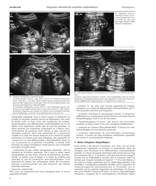 34-550-A-20 Diagnostic anténatal des uropathies malformatives Radiodiagnostic 
*A 
*B 
échographie anténatale. Dans la forme typique, le diagnostic est 
évoqué au deuxième trimestre devant un oligoamnios, une vessie 
de petite taille et deux reins très augmentés de volume, 
hyperéchogènes, sans différenciation corticomédullaire (fig 4). Les 
formes avec oligoamnios sévère sont de mauvais pronostic : le 
décès néonatal par hypoplasie pulmonaire ne s’observe plus, 
l’interruption de grossesse étant réalisée le plus souvent au 
deuxième trimestre. Mais cette pathologie est à pénétrance 
variable et il existe des formes mineures où le volume de liquide 
amniotique est normal et les reins échogènes, peu augmentés de 
volume, avec ou sans différenciation corticomédullaire. Dans ces 
cas, la poursuite de la grossesse est justifiée, la famille étant 
informée du risque d’insuffisance rénale précoce avec éventualité 
secondaire de greffe rénale ; 
– polykystose de type adulte, autosomique dominante : elle est 
rarement de révélation anténatale. Elle a alors le même aspect 
échographique qu’une forme mineure de polykystose récessive. 
Parfois, de petites zones kystiques à la limite de visibilité sont 
présentes au sein du parenchyme rénal hyperéchogène. Il est 
important de réaliser une échographie rénale des ascendants 
(parents et grands-parents) qui peut découvrir une atteinte 
parentale méconnue. 
– Syndromes malformatifs. 
Plus rares, ils comportent des reins échogènes plus ou moins 
augmentés de taille : 
– trisomie 13 : les reins sont souvent augmentés de volume, 
échogènes, avec défaut de différenciation corticomédullaire (fig 5). 
Des anomalies associées sont fréquentes ; 
– syndrome d’Ivemark II autosomique récessif : le diagnostic 
différentiel avec la polykystose rénale récessive est le plus souvent 
foetopathologique, sauf en cas de récurrence ; 
– chondrodysplasie de Jeune : elle associe une micromélie 
modérée, un thorax étroit et des reins échogènes dédifférenciés ; 
– syndrome de Laurence Moon-Bardet-Biedl : il associe aux reins 
hyperéchogènes une hexadactylie postaxiale ; 
– syndrome néphrotique de type finlandais, autosomique 
récessif : il associe des reins échogènes modérément augmentés 
de volume et une hypotrophie fréquente. 
¦ Reins échogènes idiopathiques 
Cette entité a été décrite récemment. Les reins sont de taille 
modérément augmentée ou normale, le parenchyme rénal est 
échogène sans microkyste et la différenciation corticomédullaire 
normale. Le volume de liquide amniotique reste normal tout au long 
de la grossesse (fig 6). Le pronostic est le plus souvent bon lorsqu’il 
n’existe pas de malformation associée, que le caryotype foetal est 
normal, que l’enquête familiale est négative [7, 20]. Une surveillance et 
une prise en charge postnatales par un néphrologue-pédiatre sont 
conseillées. L’échographie postnatale identifie, soit la régression de 
l’hyperéchogénicité parenchymateuse et l’évolution vers la 
normalité, soit au contraire l’apparition de pathologies une fois sur 
deux pour Estroff [13] (série de 19 foetus : 14 survies, sept pathologies 
ultérieures) : dysplasie (fig 7), hydronéphrose, microkystes faisant 
3 Dysplasie multikystique unilatérale typique. 
A. Coupe frontale à gauche, coupe axiale à droite (25 semaines d’aménorrhée 
[SA]) : masse de 6 × 3 cm dans la fosse lombaire gauche constituée de plusieurs 
kystes de taille inégale dont un principal. Tissu de soutien hyperéchogène, sans 
structure parenchymateuse rénale identifiable. 
B. Association malformative urinaire (36 SA) : rein multikystique gauche, syn-drome 
de jonction pyélo-urétérale droit. Coupe axiale transverse. Cette observa-tion 
illustre l’importance de surveiller et d’explorer le rein controlatéral à une dys-plasie 
multikystique, car porteur d’une pathologie dans un tiers des cas. 
4 Polykystose rénale au-tosomique 
récessive (23 se-maines 
d’aménorrhée). Cou-pe 
frontale des deux gros 
reins hyperéchogènes dédif-férenciés 
et oligoamnios. 
5 Reins hyperéchogènes et microkystiques d’une trisomie 13 (27 semaines d’aménor-rhée). 
À gauche, coupe axiale transverse. À droite, coupe longitudinale. Dans un contexte 
d’anamnios, l’échographie objective deux reins augmentés de taille pour l’âge gesta-tionnel, 
dédifférenciés et hyperéchogènes. Il s’agissait d’une trisomie 13. 
4 
 