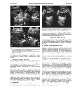 Radiodiagnostic Diagnostic anténatal des uropathies malformatives 34-550-A-20 
*A 
*B 
neurogène) ou à un reflux vésico-urétéral qu’il est difficile d’affirmer 
en anténatal et qui peut être suspecté sur la variabilité de dilatation 
urétéropyélique d’un moment à l’autre de l’examen ou d’un examen 
à l’autre. 
¦ Duplication de la voie excrétrice 
Ces anomalies sont très fréquentes, souvent asymptomatiques. La 
duplication rénale peut être évoquée dans la deuxième moitié de la 
grossesse devant la présence d’un rein de grande taille qui présente 
deux sinus séparés par un pont parenchymateux (coupe sagittale) et 
souvent une urétérohydronéphrose d’un pôle rénal (fig 12A) [27]. 
L’échographie anténatale peut suspecter une duplication complète 
compliquée : 
– pathologie du pôle supérieur : l’abouchement de l’uretère du 
pyélon supérieur est ectopique et la sténose fréquente du méat est 
responsable d’une urétérocèle parfois bilatérale (image liquidienne 
finement cerclée intravésicale). Si l’urétérocèle est basse, elle peut 
être obstructive et entraîner une urétérohydronéphrose sus-jacente 
dont la conséquence peut être une dysplasie rénale du pôle 
supérieur ; 
– pathologie du pôle inférieur : l’orifice vésical est souvent en 
ectopie intravésicale haute et à l’origine d’un reflux vésico-urétéral 
à risque de néphropathie de reflux de gravité variable. Un syndrome 
de la jonction pyélo-urétérale est la seconde complication. 
¦ Urétérocèles 
L’échographie anténatale n’est pas très fiable pour différencier 
l’urétérocèle intravésicale des urétérocèles ectopiques. L’urétérocèle 
intravésicale simple sur uretère unique est la plus fréquente. 
L’association d’une duplication rénale et d’une urétérocèle fait 
penser à une urétérocèle ectopique développée le plus souvent sur 
l’uretère supérieur d’une duplication totale (fig 13). 
BAS APPAREIL : MÉGAVESSIES 
Il faut les différencier d’une vessie normale remplie : au troisième 
trimestre, elle peut atteindre 5 à 6 cm de hauteur. La paroi est fine, 
les reins sus-jacents sont d’aspect normal, de même que le liquide 
amniotique. La constatation d’une miction confirme le diagnostic de 
normalité. 
¦ Valves de l’urètre postérieur (VUP) 
L’obstacle (coalescence des freins inférieurs du veru montanum, 
diaphragme urétral), plus ou moins obstructif, se situe sur l’urètre 
postérieur, et bien sûr chez le garçon. Sa fréquence est de 1/5 000 à 
1/10 000. La vessie, de grande taille, est visible dès le deuxième 
trimestre, augmente progressivement : elle prend les caractéristiques 
d’une vessie de lutte, avec paroi épaisse. Un récessus vésical 
inférieur est visible sur le plan frontal : il correspond à la dilatation 
de l’urètre postérieur. Le retentissement d’amont est d’importance 
variable : urétérohydronéphrose bilatérale, parfois asymétrique 
(fig 14). 
Le pronostic est péjoratif si l’obstacle, survenu précocement, se 
manifeste par un retentissement en amont important, entraînant un 
oligoamnios progressif avec risque de dysplasie rénale secondaire. 
Il est difficile d’analyser l’échostructure d’un parenchyme laminé, 
mais on évoque une dysplasie s’il est hyperéchogène et présente 
des microkystes [21]. Celle-ci est confirmée par une exploration 
biochimique des urines foetales prélevées aseptiquement sous 
contrôle échoguidé : les dosages des principaux paramètres étudiés 
sont au-delà des seuils déterminés : Na+ supérieur à 75 mEq/L, bêta- 
2-microglobuline supérieure à 10 mg/L [24], ou supérieure à 6 mg/L 
après 20 SA [15]. 
En dehors de ces situations où tous les signes de gravité sont réunis, 
il n’est pas possible actuellement d’évaluer en anténatal le pronostic 
rénal d’une uropathie obstructive patente et bilatérale : les ponctions 
d’urine foetale sont discutées dans les situations intermédiaires car 
les derniers résultats ont montré des discordances qui risquent de 
rassurer par excès ou d’inquiéter inutilement les couples sur l’avenir 
rénal de leur enfant [4]. L’évaluation de la bêta-2-microglobuline 
plasmatique foetale après cordocentèse [26] paraît donner le meilleur 
critère de filtration glomérulaire. Elle reste en cours de validation 
quant à sa valeur pronostique sur la fonction rénale postnatale. 
L’absence de signe de gravité anténatal est corrélée à l’absence 
d’altération de la fonction rénale dans la petite enfance (30 VUP avec 
suivi anté- et postnatal 1989-1996) [12]. 
12 Méga-uretère du pyélon supérieur sur duplication rénale (23 semaines d’aménor-rhée). 
A. La dilatation du pyélon supérieur est identifiable sur la coupe longitudinale (à 
gauche) et est mesurée à 15 mm sur le plan axial (à droite). 
B. Le ruban transsonique et sinueux du méga-uretère est bien visualisé sur ces 
plans de coupe frontaux. 
13 Urétérocèles doubles sur duplication bilatérale (31 semaines d’aménorrhée) en 
coupe axiale, le double cloisonnement vésical est bien visible à gauche. Il s’y associait 
deux méga-uretères et une hydronéphrose intéressant chaque pyélon supérieur. 
7 
 