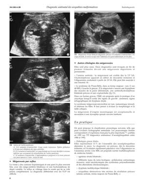 34-550-A-20 Diagnostic anténatal des uropathies malformatives Radiodiagnostic 
*A 
*B 
*C 
¦ Mégavessie par reflux 
La vessie a des contours hypotoniques et une paroi le plus souvent 
fine, avec des méga-uretères bilatéraux et une hydronéphrose de 
degré variable. Le reflux se vidange dans la vessie qui ne se vide 
jamais complètement. Le diagnostic différentiel avec les VUP est 
difficile. 
¦ Autres étiologies des mégavessies 
Elles sont plus rares. Deux diagnostics sont évoqués en fin de 
premier trimestre devant une mégavessie importante et 
permanente : 
– l’atrésie urétrale : la mégavessie est visible dès la 13e SA, 
l’hydronéphrose apparaît en début de deuxième trimestre et 
l’oligoamnios seulement à partir de 18 SA. Elle peut être associée à 
une trisomie 18 ; 
– le syndrome de Prune-Belly, dans sa forme majeure : rare (1 sur 
40 000), il touche le garçon. À la mégavessie s’associe une hypoplasie 
des muscles de la paroi abdominale, une urétérohydronéphrose 
bilatérale précoce et une cryptorchidie (fig 15). 
Dans ces formes graves, l’IMG est proposée après la pratique d’un 
caryotype lorsqu’il existe des signes de gravité : anamnios, signes 
échographiques de dysplasie rénale. 
Le syndrome mégavessie-microcôlon est rare, autosomique récessif, 
et intéresse les filles. Il faut penser à évaluer la morphologie et la 
taille coliques. 
La mégavessie d’origine neurologique est exceptionnelle et 
secondaire à une dysraphie spinale ouverte lombaire. 
En pratique 
On peut proposer la classification pronostique suivante, telle que 
peut l’évaluer l’échographie anténatale. Les pourcentages donnés 
correspondent à l’expérience française la plus importante [11], publiée 
en 1995 sur 737 diagnostics anténataux d’uronéphropathies entre 
1980 et 1992. 
– Pathologies graves létales. 
Elles représentent 13 % de l’ensemble des uronéphropathies 
dépistées in utero. Le diagnostic est précoce, dès le deuxième 
trimestre, et l’évolution rapidement péjorative vers l’oligoamnios ou 
l’anamnios sévère. Une IMG est proposée (centre multidisciplinaire 
de médecine foetale) : 
– agénésie rénale bilatérale ; 
– différents types de reins kystiques : polykystose autosomique 
récessive, reins microkystiques des syndromes polymalformatifs 
et des aberrations chromosomiques ; 
– dysplasie multikystique bilatérale ; 
– uropathies obstructives très sévères de révélation précoce 
(atrésie urétrale, forme majeure de Prune-Belly...). 
14 Valves de l’urètre postérieur. 
A. 23,5 semaines d’aménorrhée. Coupe axiale transverse. Pyélon globuleux 
à 10 mm avec dilatation des tiges calicielles. 
B. 23,5 semaines d’aménorrhée. La coupe frontale sur la vessie identifie le récessus 
inférieur qui correspond à la vésicalisation de l’urètre postérieur. 
C. 32 semaines d’aménorrhée. L’hydronéphrose a progressé et la vessie présente 
une paroi épaissie à 3 mm : vessie de lutte. 
15 Mégavessie Prune-Belly de diagnostic précoce (13 semaines d’aménorrhée). En 
coupe frontale, la vessie occupe tout l’abdomen et la paroi abdominale est très fine. 
8 
 