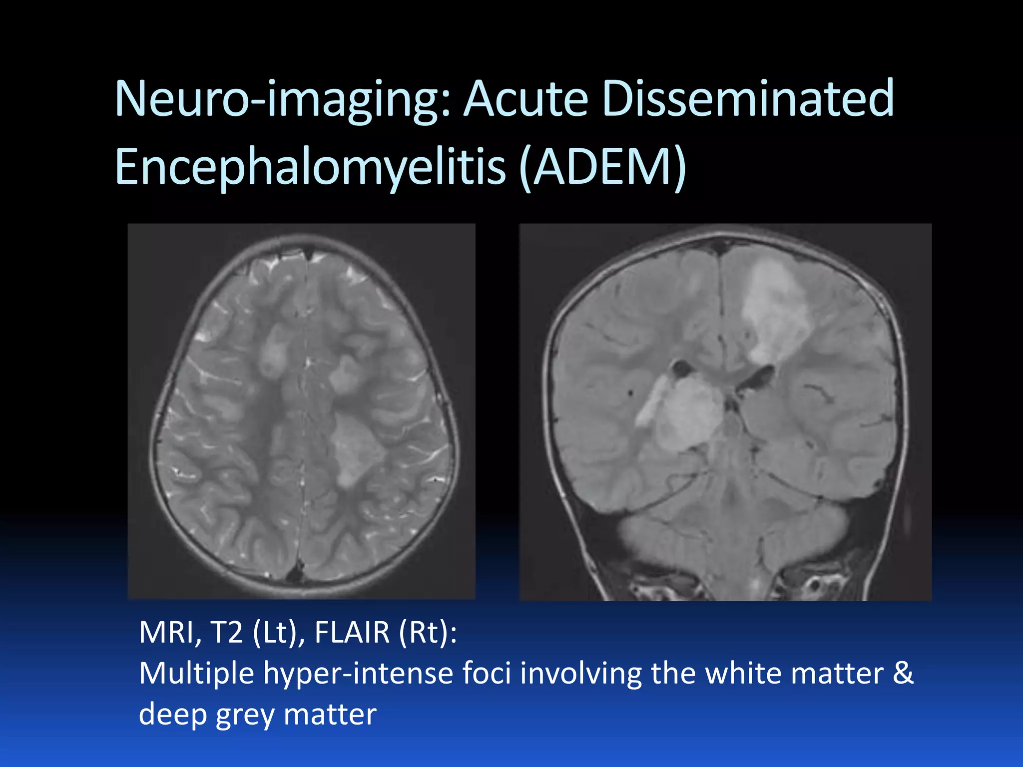 Diagnostic approach to acute encephalopathy | PDF