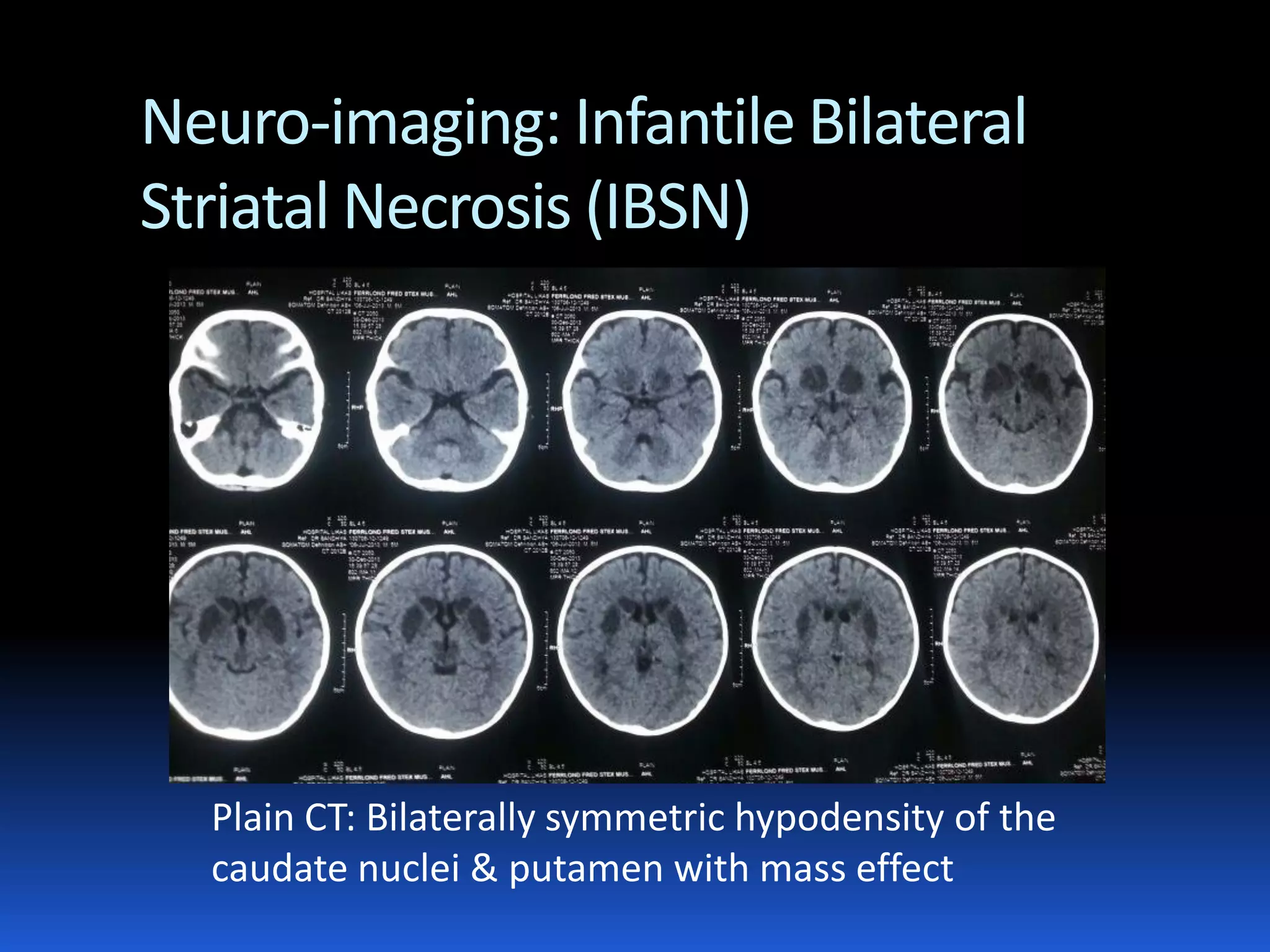 Diagnostic approach to acute encephalopathy | PDF