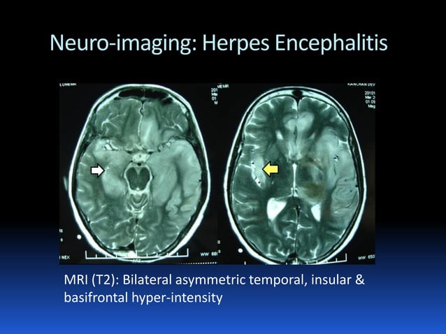 Diagnostic approach to acute encephalopathy | PDF