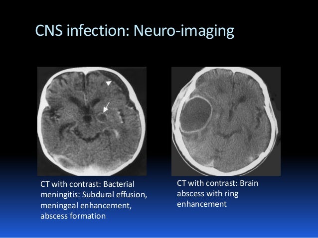 acute encephalopathy