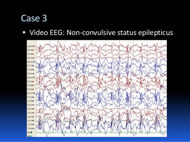 Status Epilepticus In Children  Blog Kata2