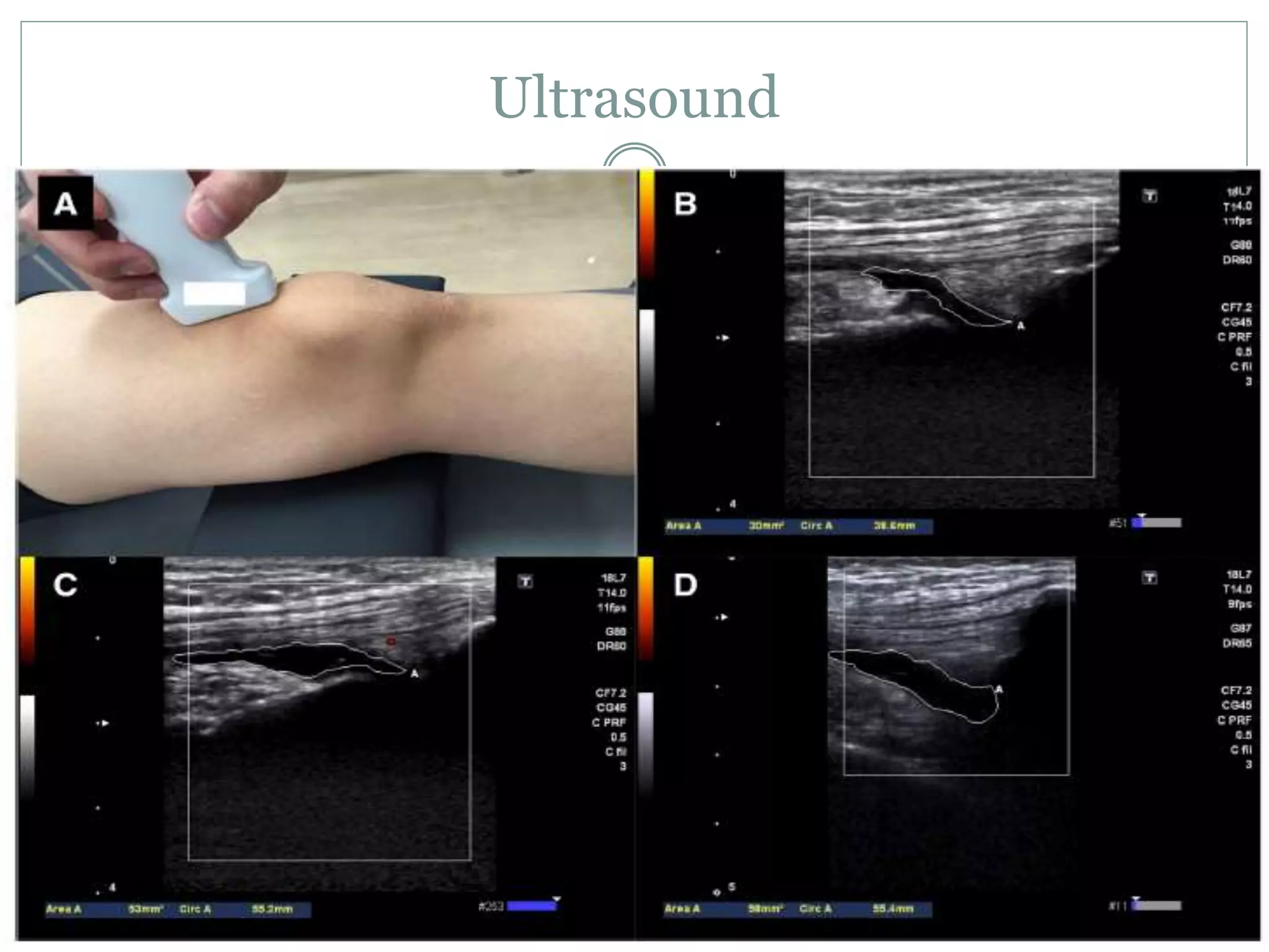 Sweep Testing Diagnostic approach to knee joint effusion | PPTX