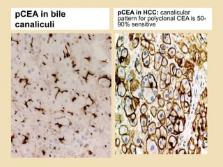 Diagnostic approach to metastatic adenocarcinoma | PPTX