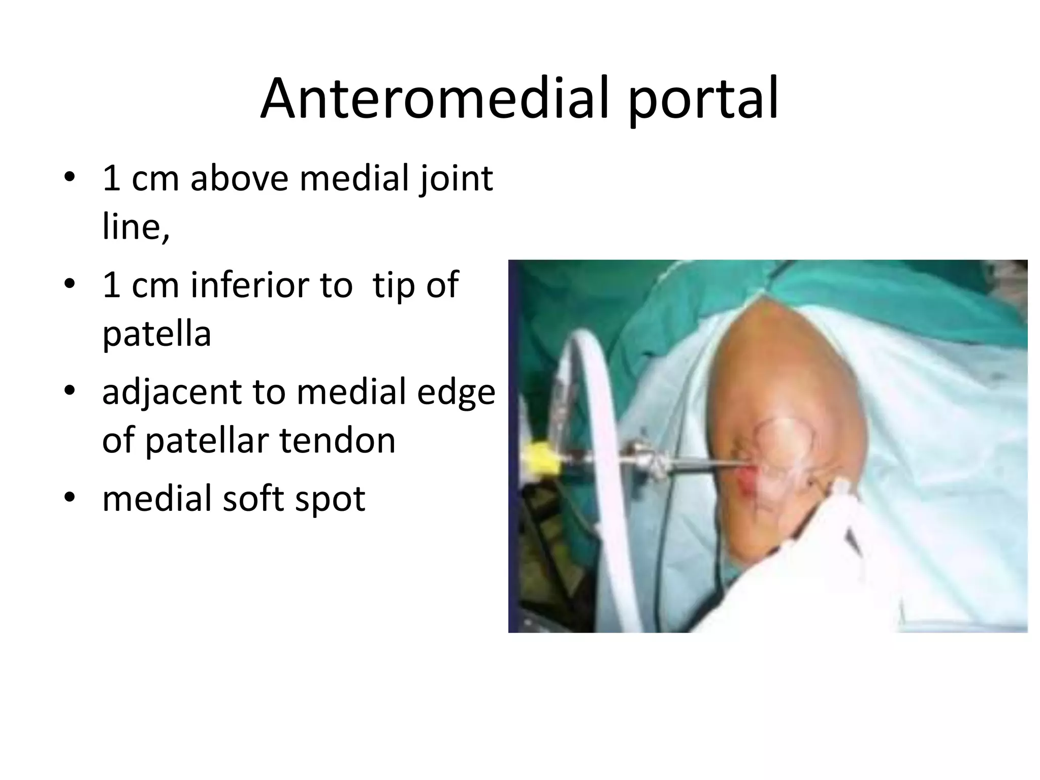 Anteromedial portal
• 1 cm above medial joint
line,
• 1 cm inferior to tip of
patella
• adjacent to medial edge
of patellar tendon
• medial soft spot
 
