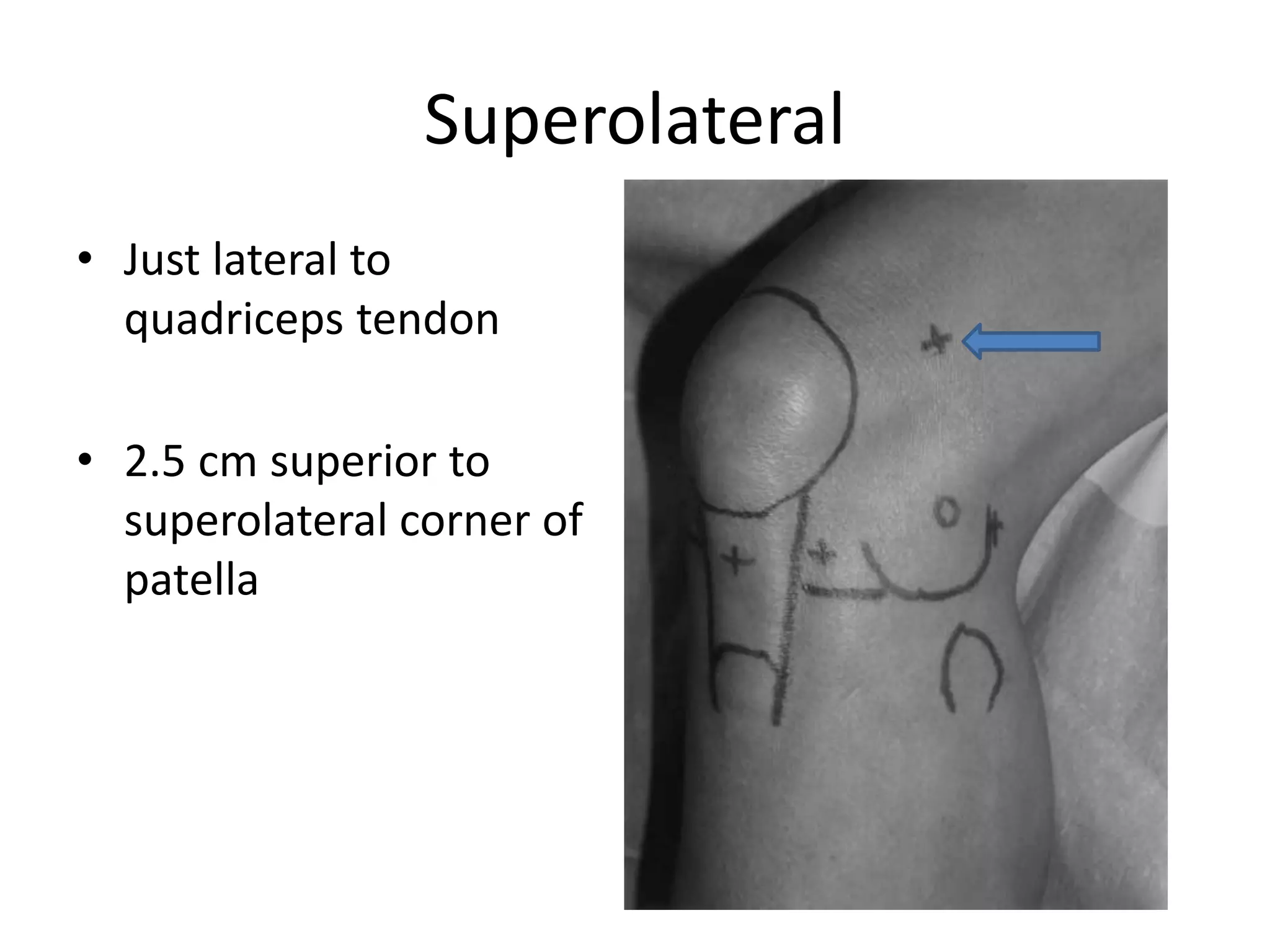 Superolateral
• Just lateral to
quadriceps tendon
• 2.5 cm superior to
superolateral corner of
patella
 