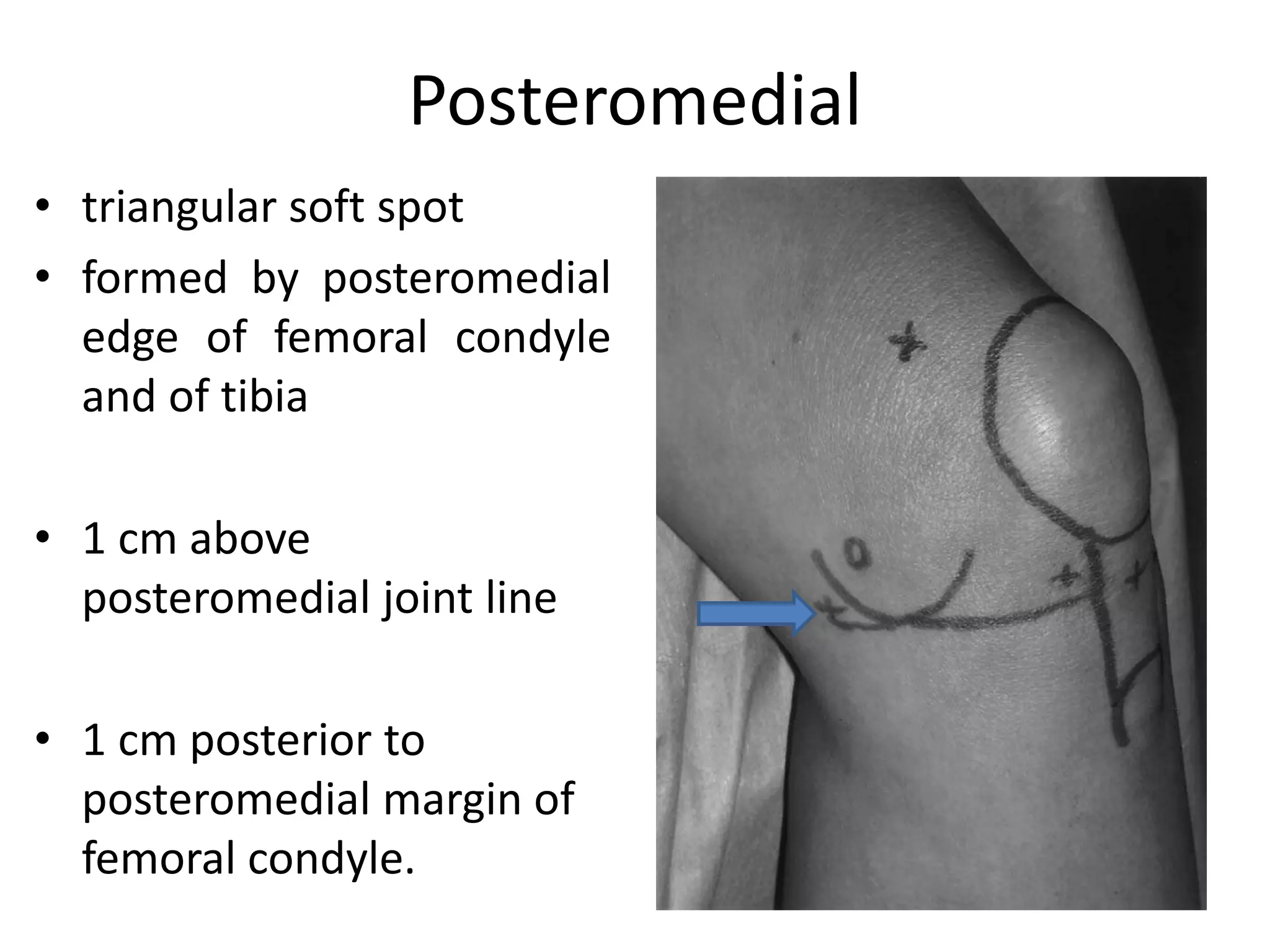Posteromedial
• triangular soft spot
• formed by posteromedial
edge of femoral condyle
and of tibia
• 1 cm above
posteromedial joint line
• 1 cm posterior to
posteromedial margin of
femoral condyle.
 