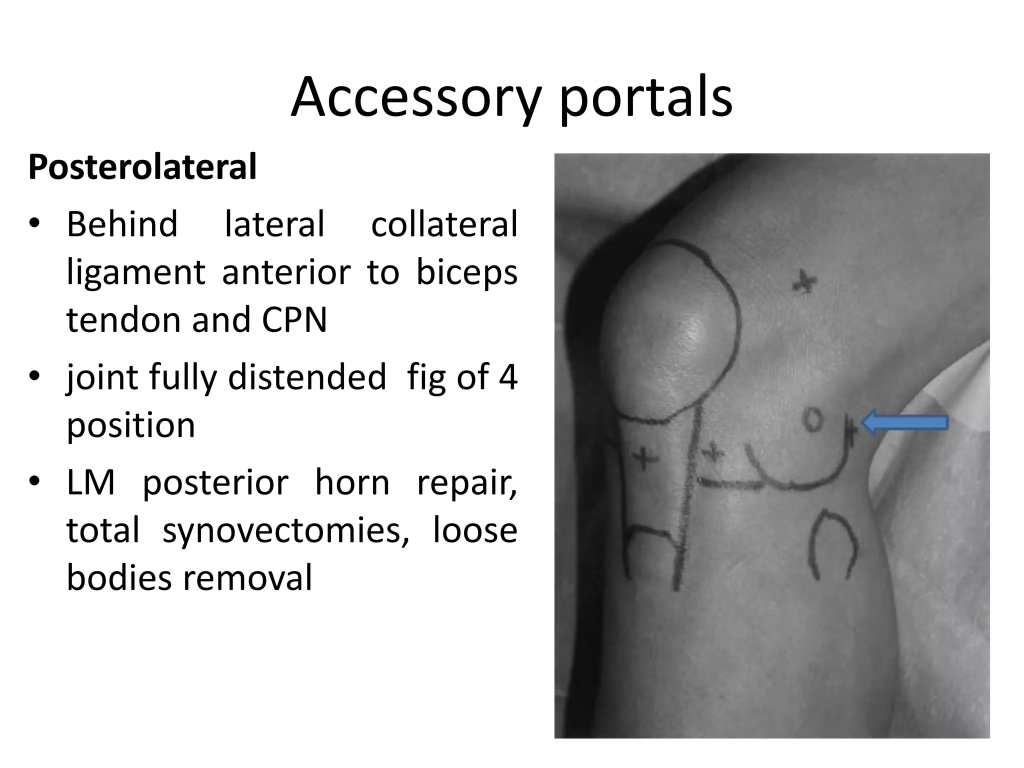 Accessory portals
Posterolateral
• Behind lateral collateral
ligament anterior to biceps
tendon and CPN
• joint fully distended fig of 4
position
• LM posterior horn repair,
total synovectomies, loose
bodies removal
 