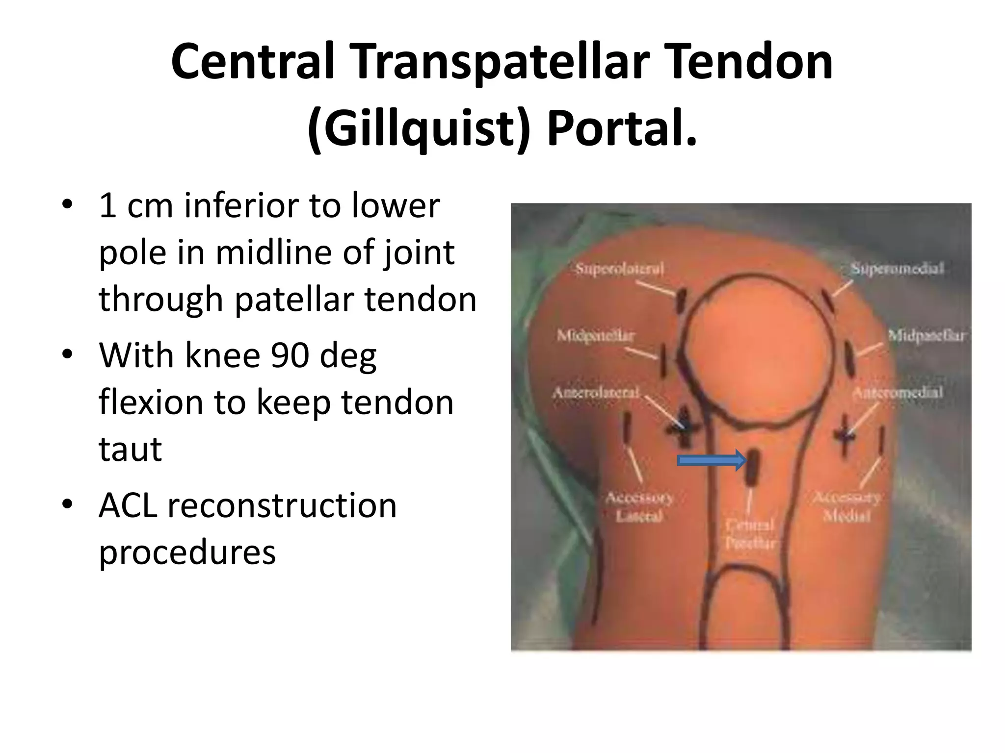 Central Transpatellar Tendon
(Gillquist) Portal.
• 1 cm inferior to lower
pole in midline of joint
through patellar tendon
• With knee 90 deg
flexion to keep tendon
taut
• ACL reconstruction
procedures
 
