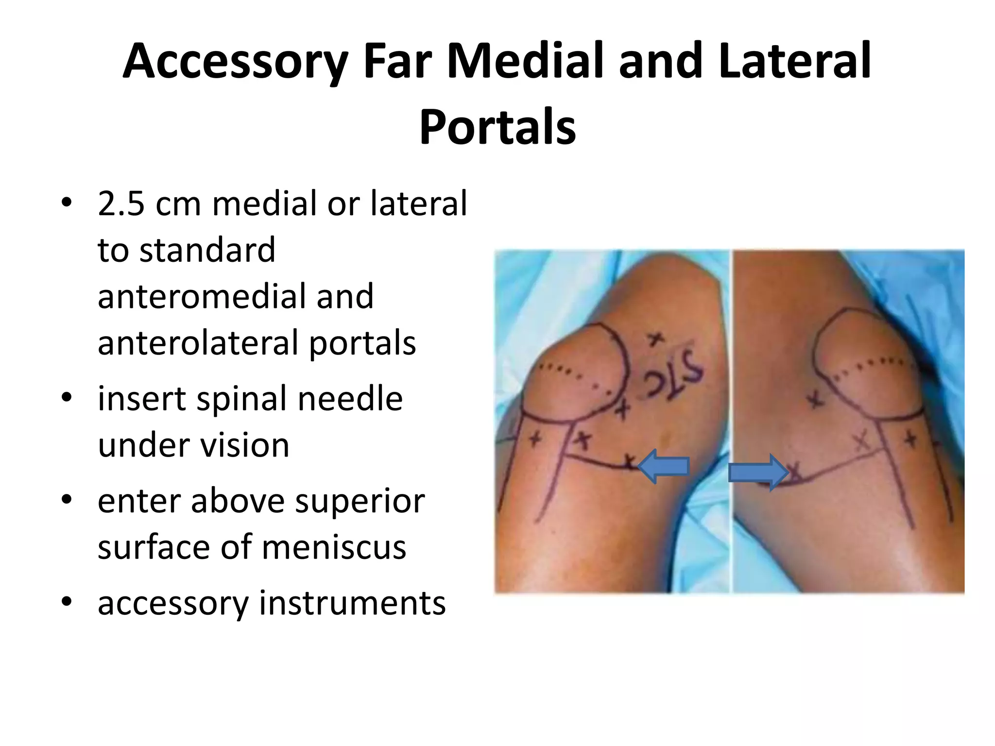 Accessory Far Medial and Lateral
Portals
• 2.5 cm medial or lateral
to standard
anteromedial and
anterolateral portals
• insert spinal needle
under vision
• enter above superior
surface of meniscus
• accessory instruments
 
