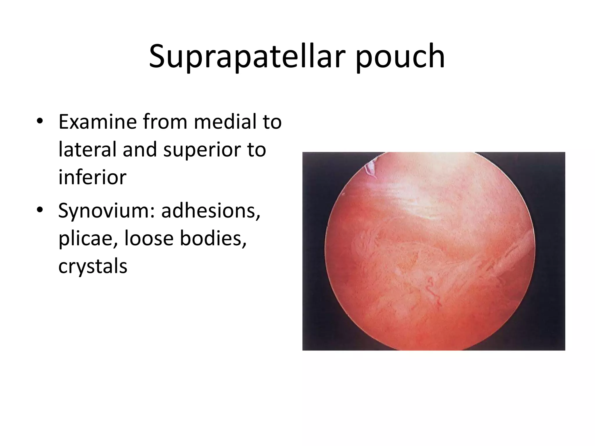 Suprapatellar pouch
• Examine from medial to
lateral and superior to
inferior
• Synovium: adhesions,
plicae, loose bodies,
crystals
 