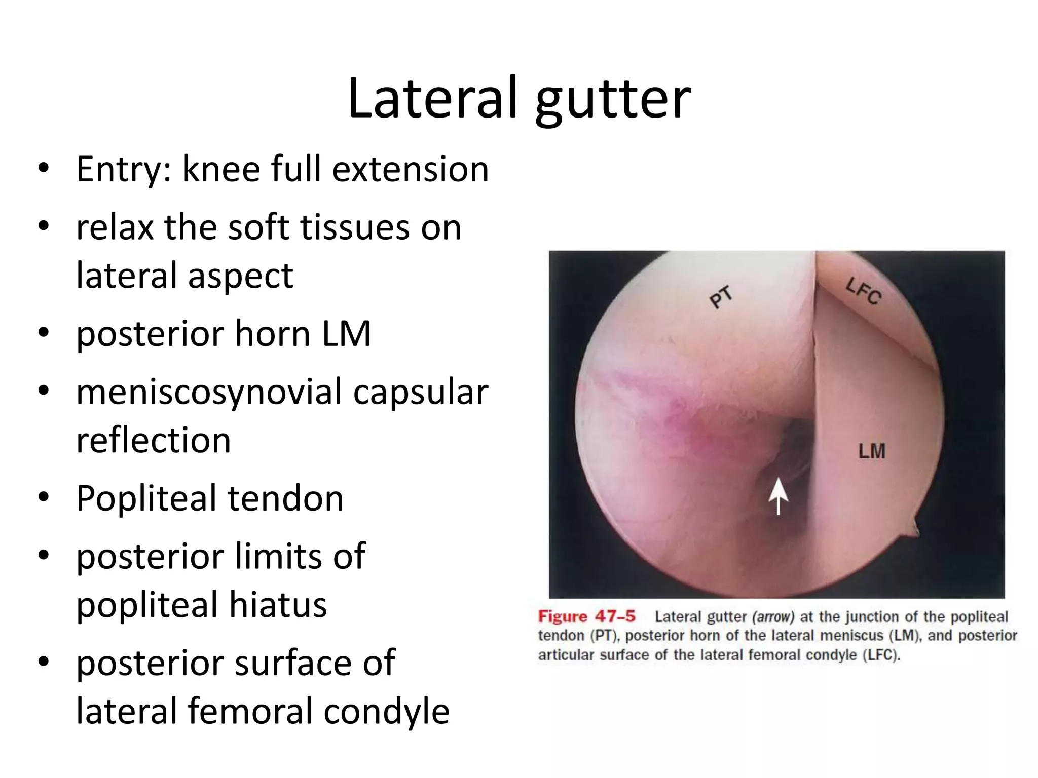 Lateral gutter
• Entry: knee full extension
• relax the soft tissues on
lateral aspect
• posterior horn LM
• meniscosynovial capsular
reflection
• Popliteal tendon
• posterior limits of
popliteal hiatus
• posterior surface of
lateral femoral condyle
 