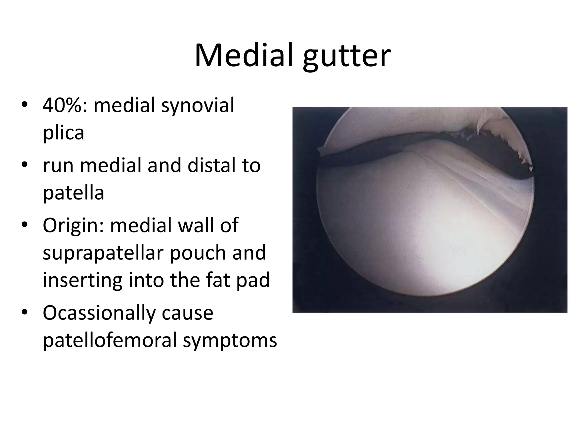 Medial gutter
• 40%: medial synovial
plica
• run medial and distal to
patella
• Origin: medial wall of
suprapatellar pouch and
inserting into the fat pad
• Ocassionally cause
patellofemoral symptoms
 