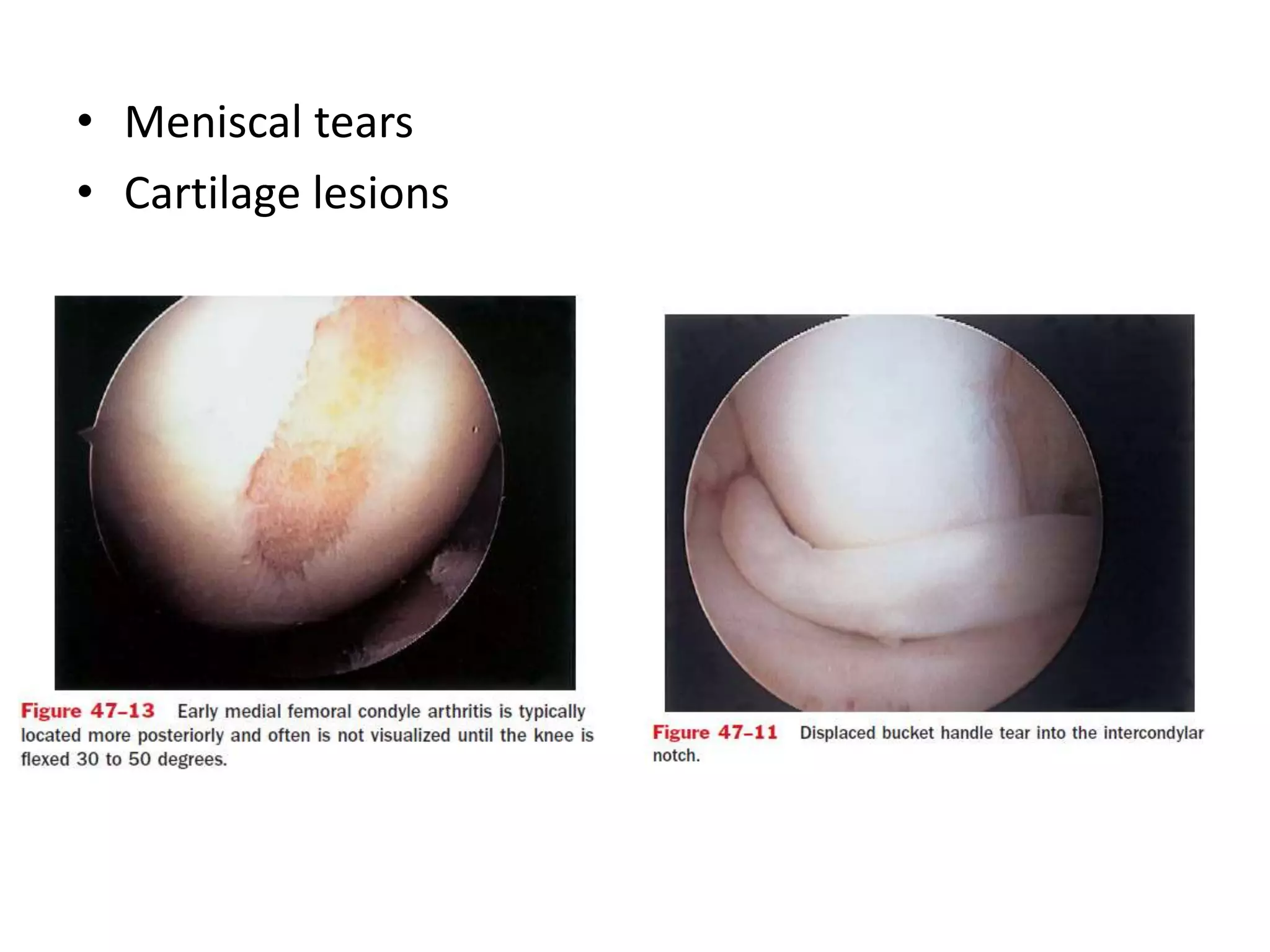 • Meniscal tears
• Cartilage lesions
 